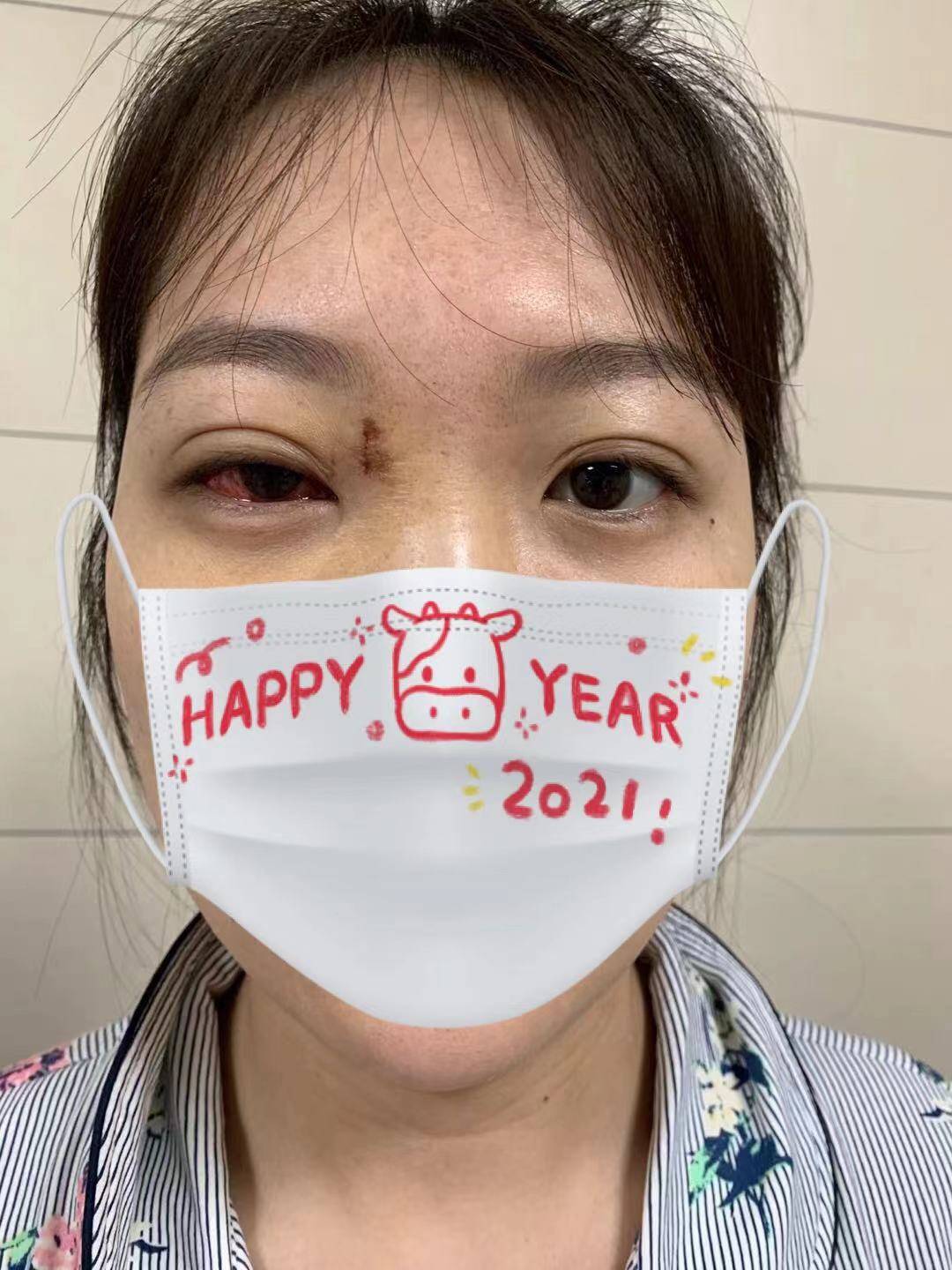 "斜视矫正 固定术",让她走出废用性斜视的阴霾