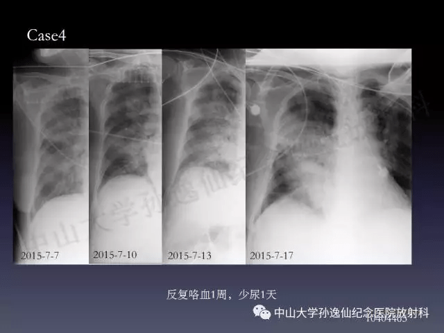 肺出血的影像学特征