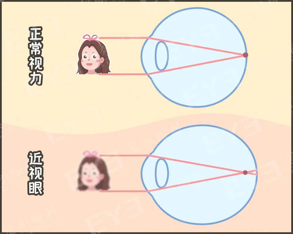 远视储备 随着身体的逐步发育 眼轴会和身高一样一点点慢慢增长 眼睛