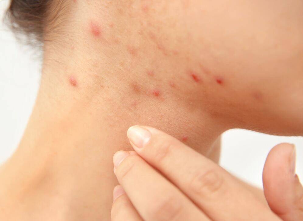 女人感染hpv,手上1个提示或是信号,别以为是皮肤过敏