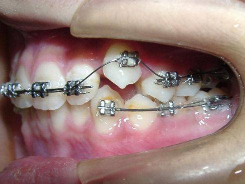 虎牙矫正可以采用一般正畸,通过对虎牙患者不同牙颌面的畸形程度