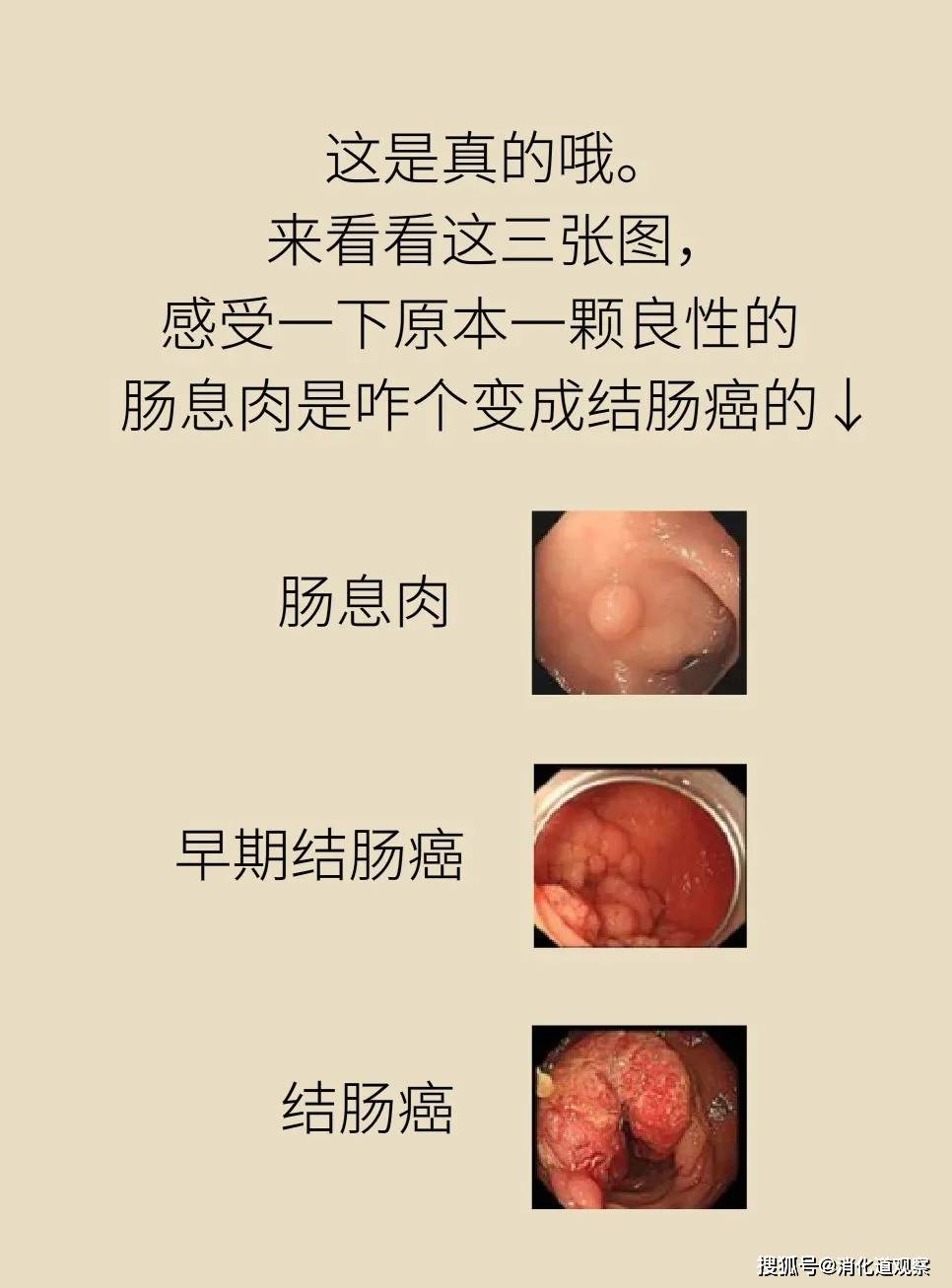 长了肠息肉不用切?先问问大肠癌同不同意!