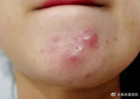 【长春肤康皮肤】为什么下巴总是反复长痘痘?