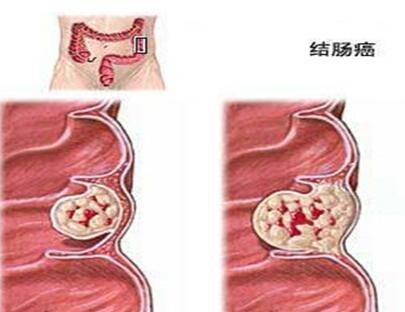 体内有癌,大便异样?大便出现4个"症状,或许是肠癌作乱