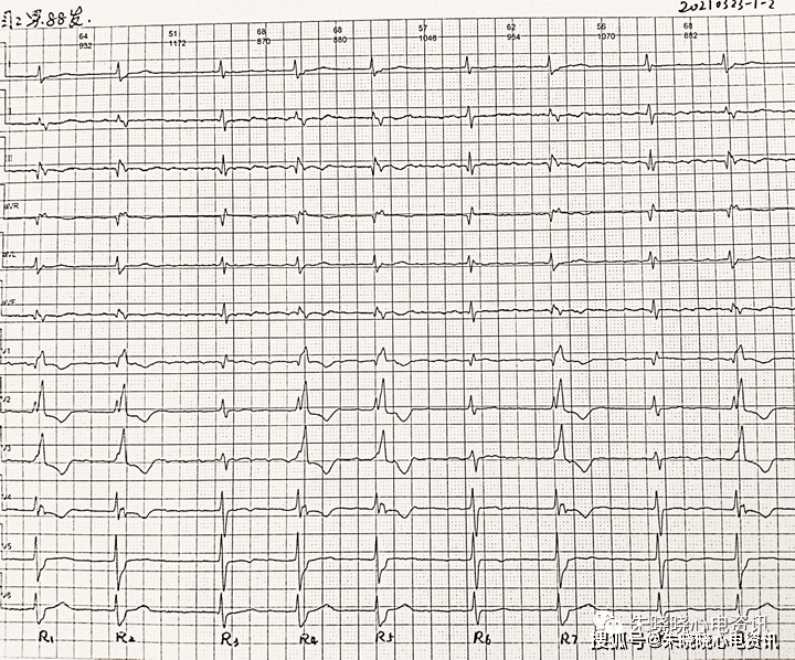 卢老师看心电图心房颤动伴间歇性完全性右束支阻滞