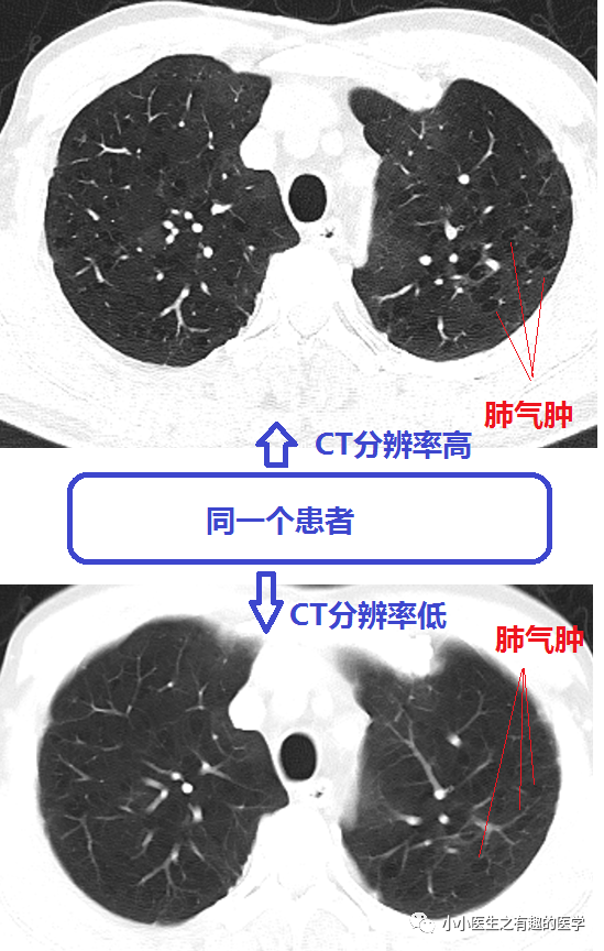 ct经典图谱:肺气肿ct典型图谱,一学就会