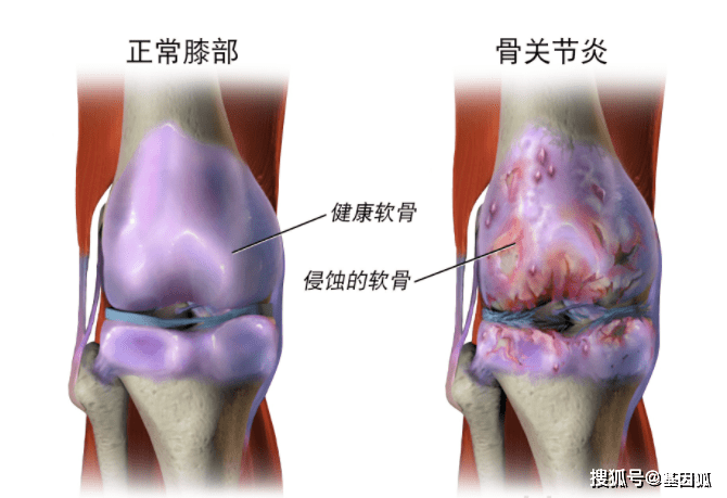 膝关节骨关节炎