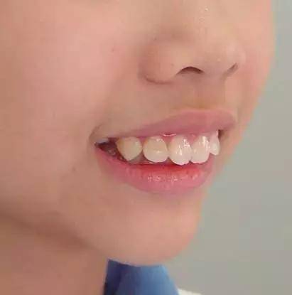 这20种儿童牙颌畸形12岁前必须处理