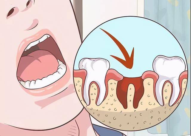 新疆臻美口腔:拔牙后的"牙洞"恢复期需要多久才能愈合