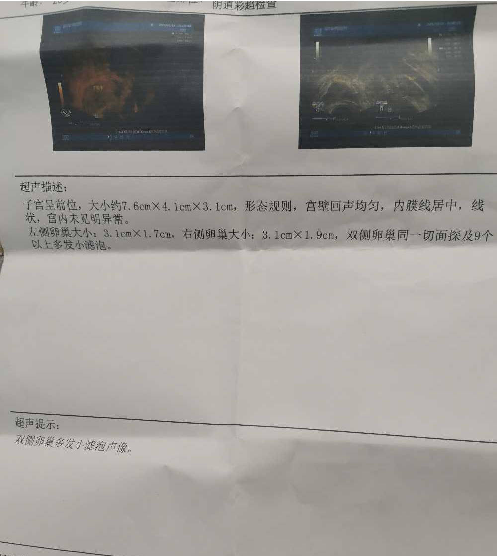 双侧多囊卵巢自然怀孕,怀孕本来就是惊喜呀