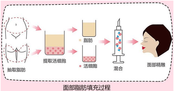 脂美:脂肪填充失败修复:术后脂肪液化是怎么回事?一定