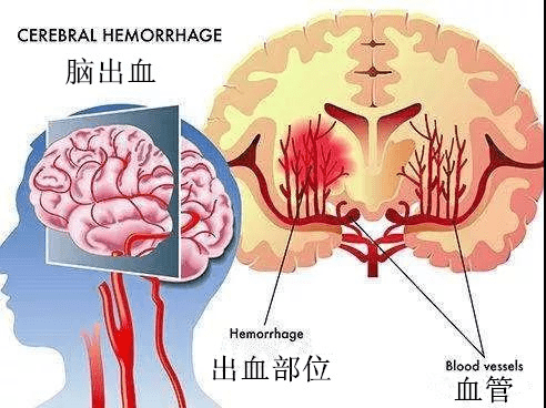 脑梗塞和脑溢血能不能治愈?