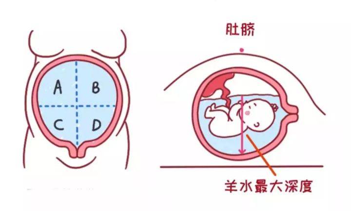 线和腹白线为标志将子宫直角分成四个象限,测量各象限最大羊水池的