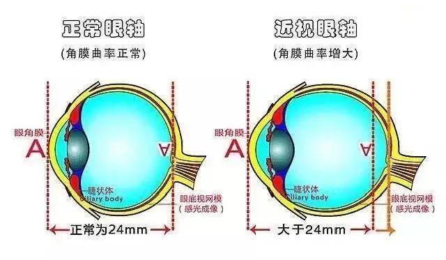眼部发育不全 (眼轴过短)形成远视眼,生长过度 (眼轴过长)则形成近视