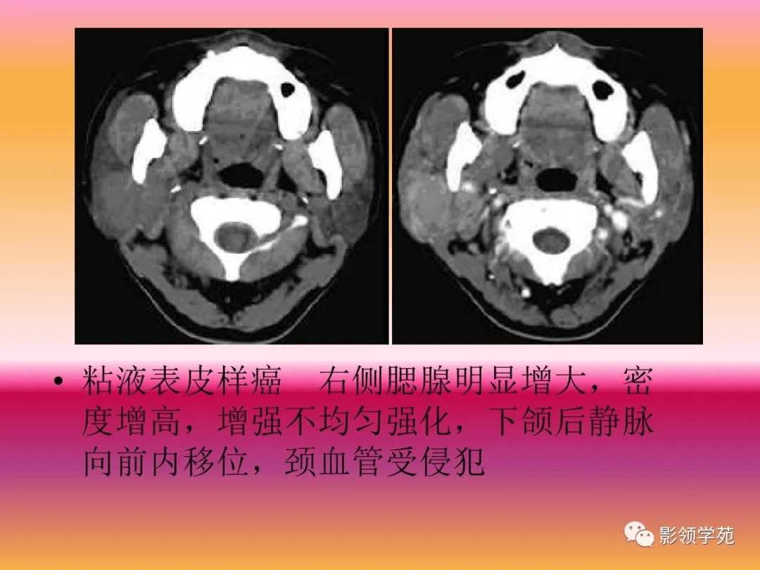 腮腺疾病的ct诊断与鉴别诊断