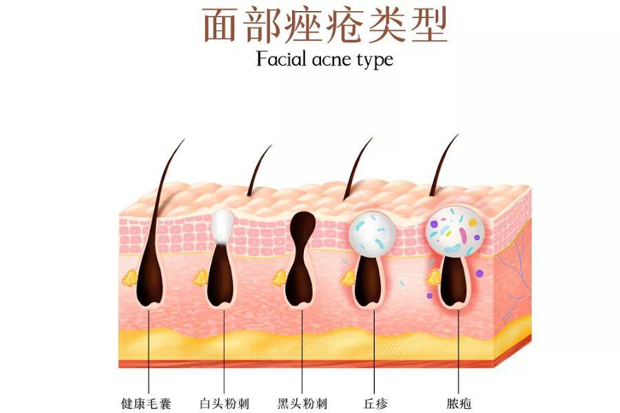 腾海霞医生介绍,痤疮是毛囊,皮脂腺的一种 慢性炎症性皮肤病,也是医学