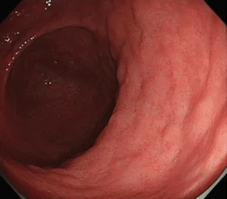 萎缩性胃炎伴肠上皮化生胃镜图像