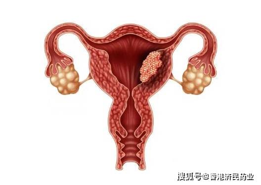 首个治疗子宫内膜癌抗pd-1疗法jemperli(dostarlimab)