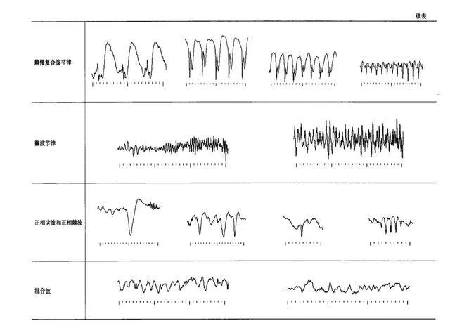 儿童脑电图基础与判读解析_波形