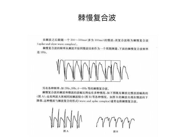 儿童脑电图基础与判读解析