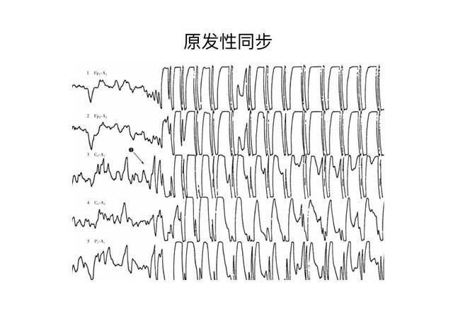 儿童脑电图基础与判读解析_波形