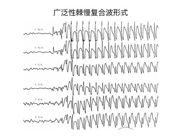 儿童脑电图基础与判读解析