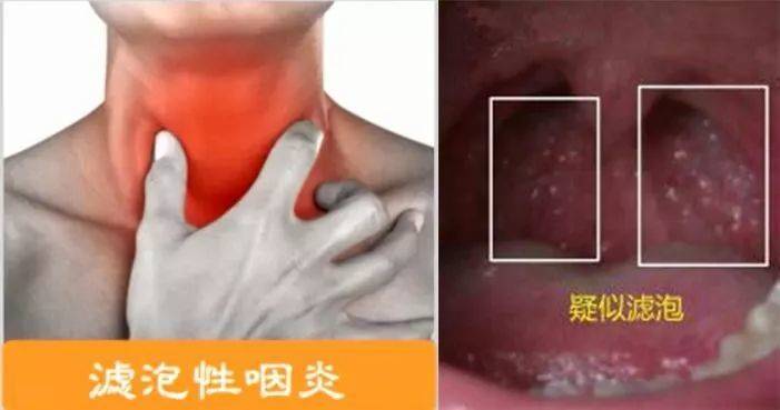 贵阳铭仁耳鼻喉医院:女子患咽喉炎3年反复发作,这个症状你要注意了!