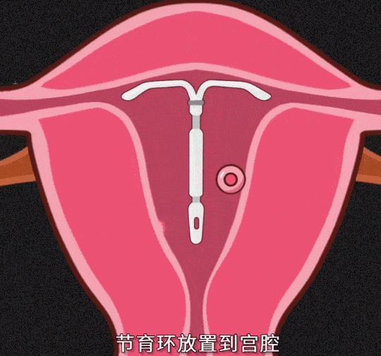 永别了,避孕环:避孕,从不止是女性的事!