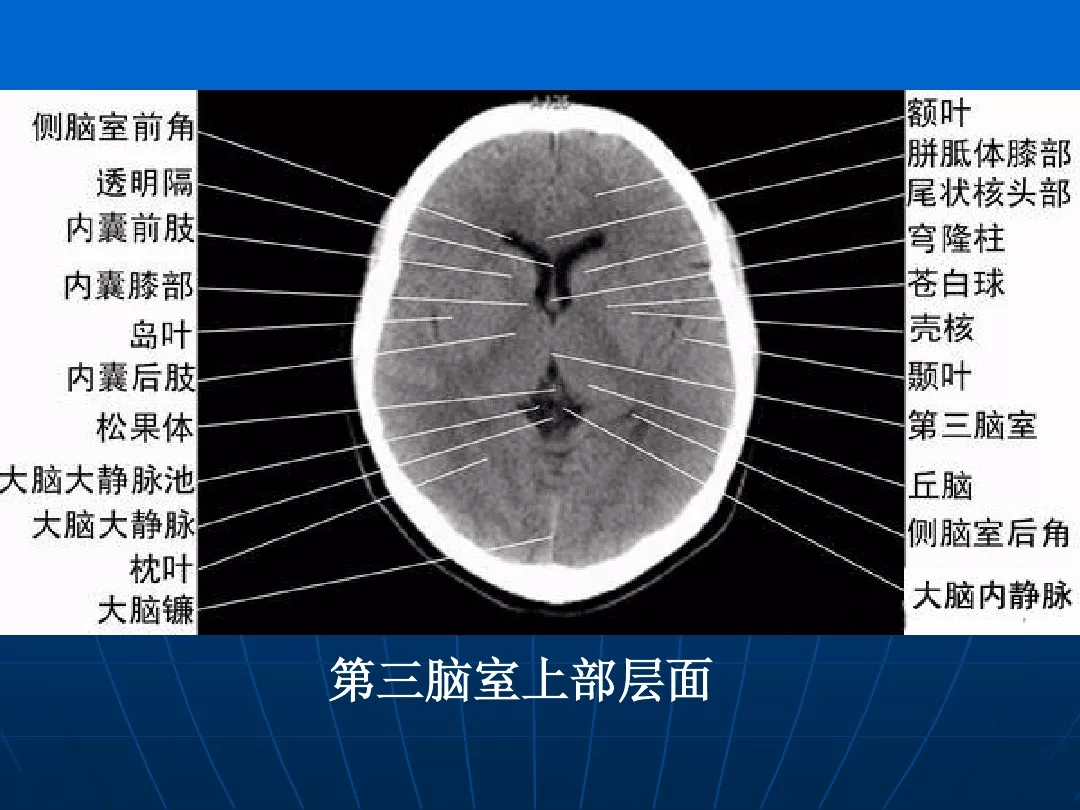 影像总结头颅ct基本知识与常见病变