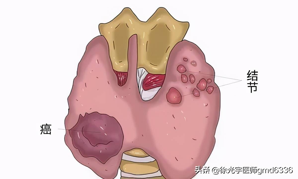 甲状腺结节恶变时,身体会有异常变化,只要察觉,就请及时治疗