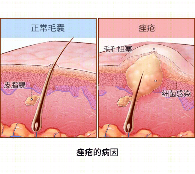 皮肤表面,常年驻扎着一种菌类,名为痤疮杆菌.