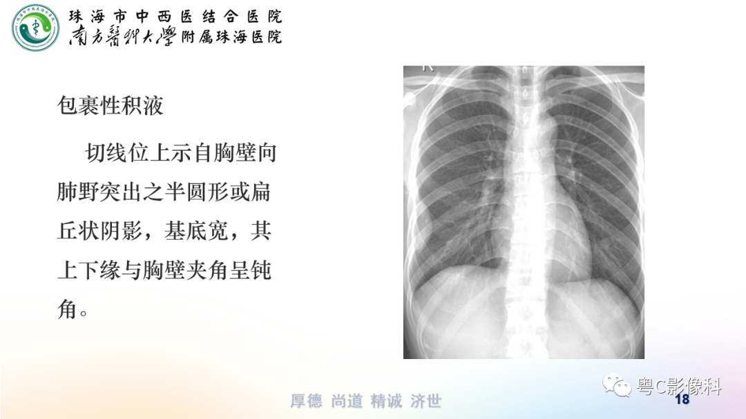 气胸,胸腔积液,肋骨骨折影像表现