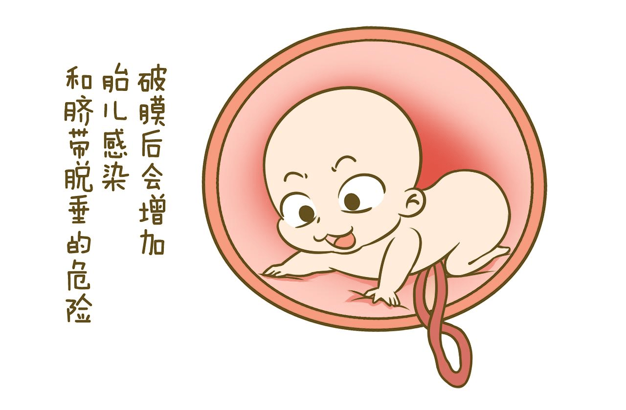 2,羊膜腔压力升高:常见于双胎妊娠及羊水过多.