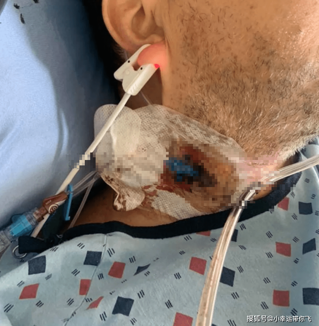 加拿大健康男子打疫苗后 被切除2米肠子! 出现这种情况需打911!