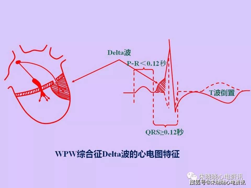 预激综合征(ppt)