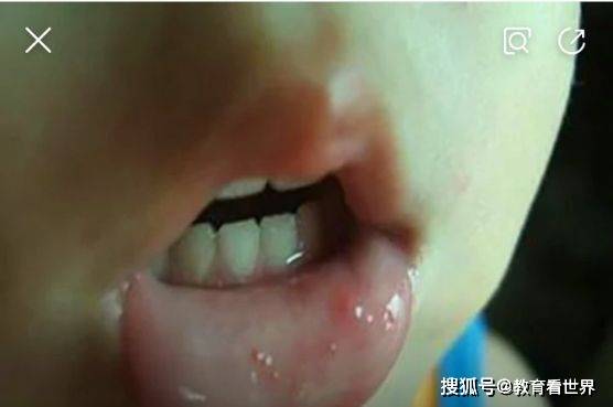 柳城县中心幼儿园手足口病和疱疹性咽峡炎防控知识
