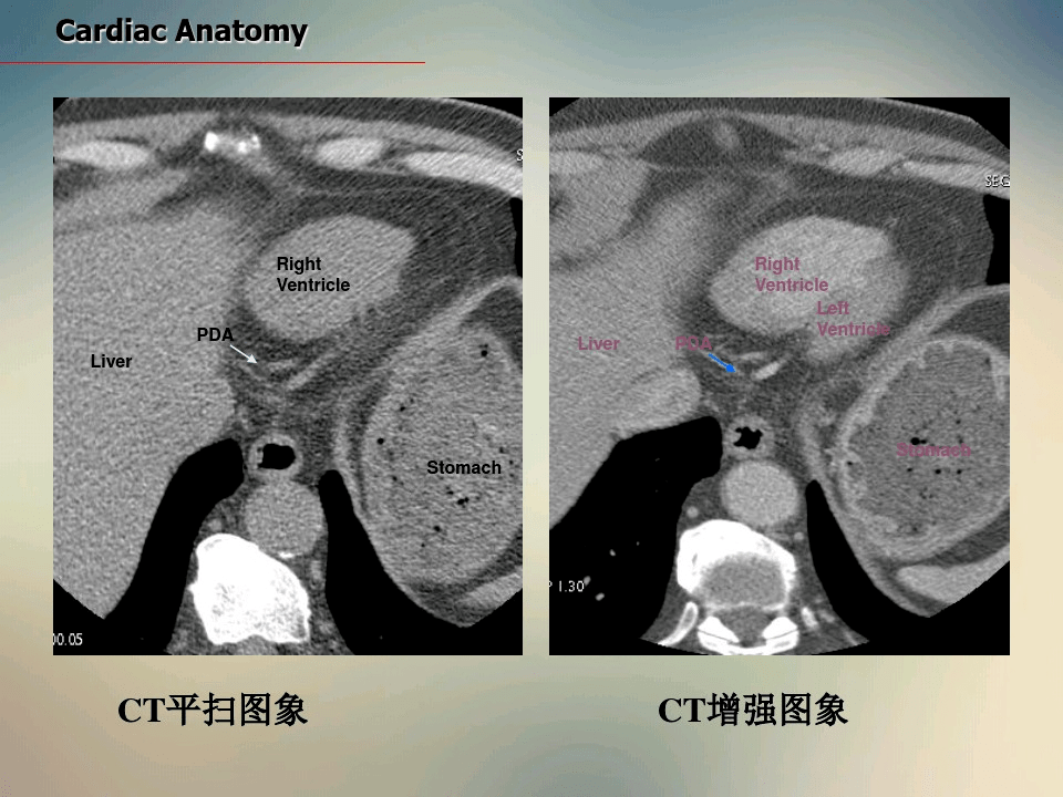 心脏ct断面解剖_平台