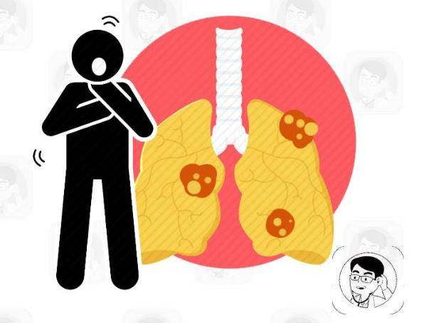 早期肺癌的6个信号,你不可不知