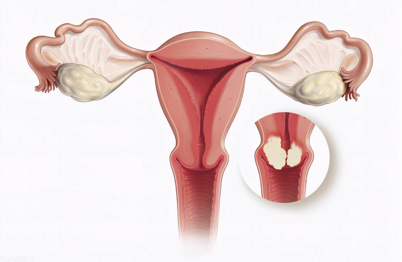 宫颈癌并非静悄悄地来,医生提醒:3个信号是"提醒",速查hpv