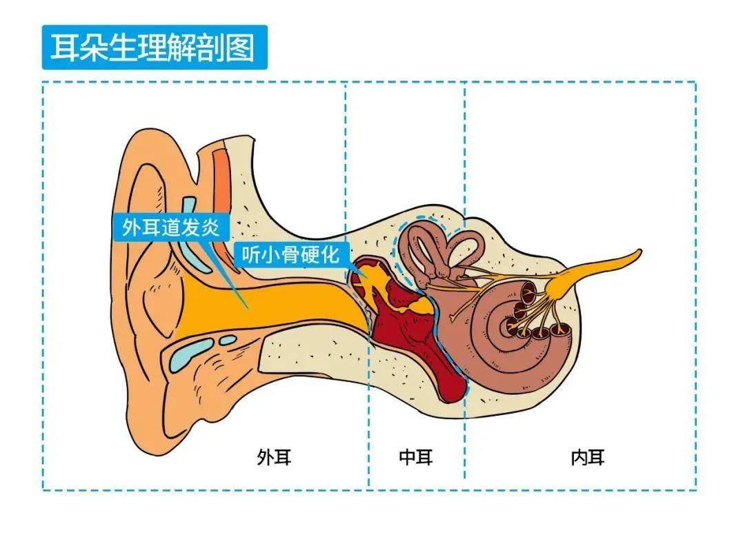 感音神经性听力损失往往是由内耳及耳蜗后病变引起,比如遗传性听