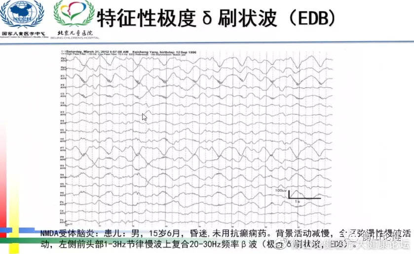 脑电图应用在癫痫领域中的局限性