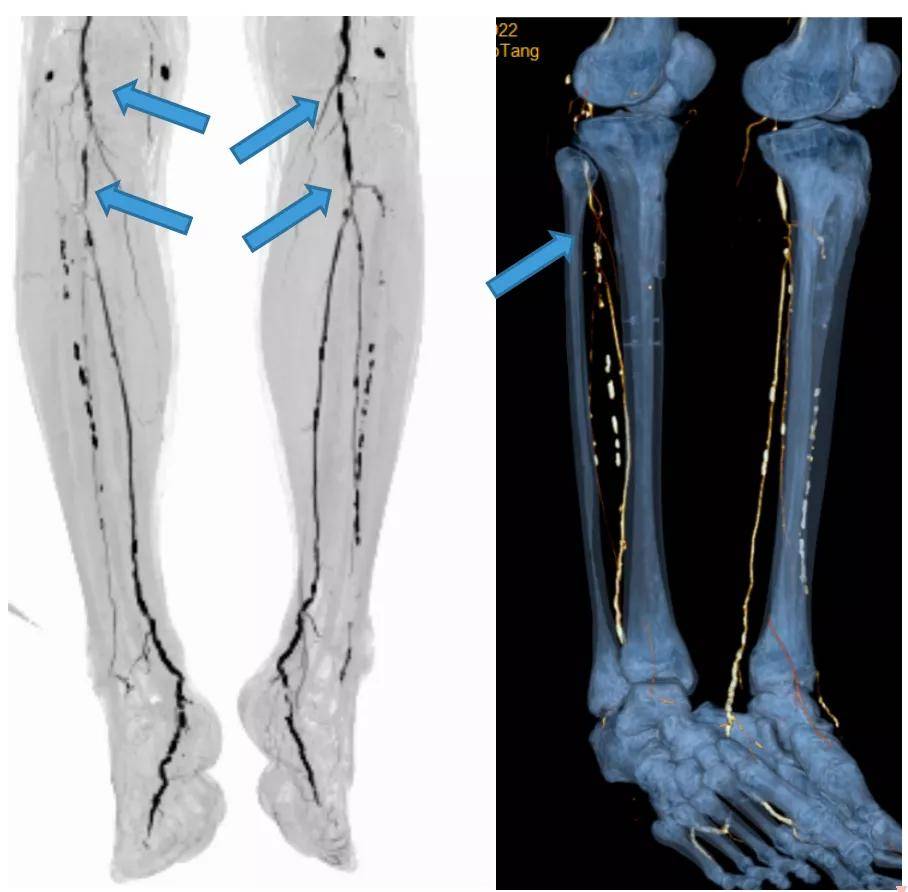 cta提示患者双下肢动脉多发狭窄或闭塞,而引起肢体缺血症状,导致右足