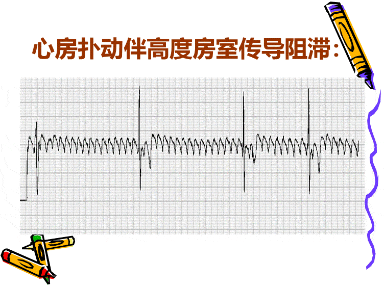 太全了!心电图基础知识讲解,值得收藏!