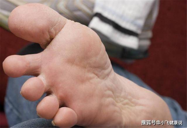 肝不好的人,脚底通常会出现这3个"变化",细心观察不难