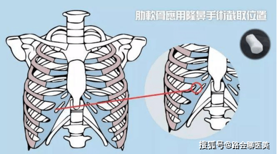 肋软骨隆鼻是要完全切断肋骨,还是切片就可以?