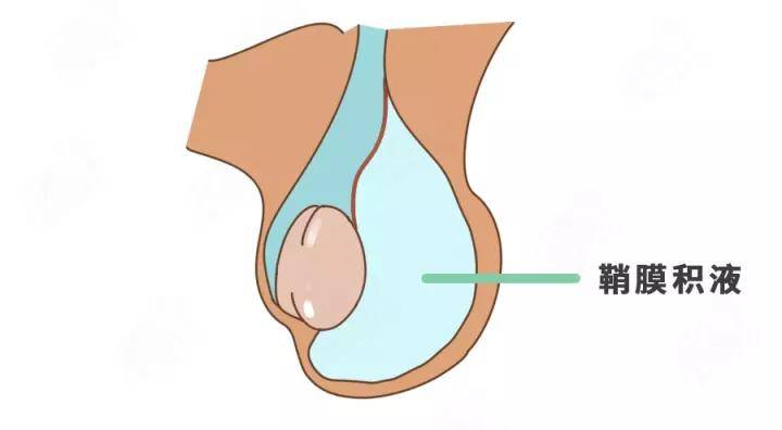 图片来源:科学家庭育儿原创鞘膜积液的形成源头还是鞘状突.