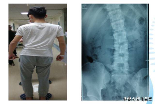 这是一位16岁青少年的脊椎,它因疼痛而发生变形,侧弯程度严重到肉眼