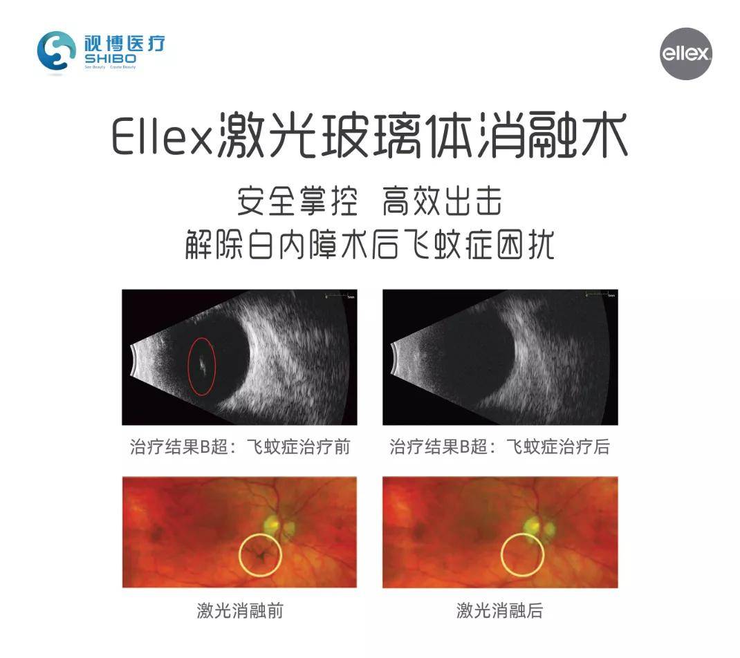 安全掌控,高效出击 适用于激光玻璃体消融术,激光虹膜切开术,嚢