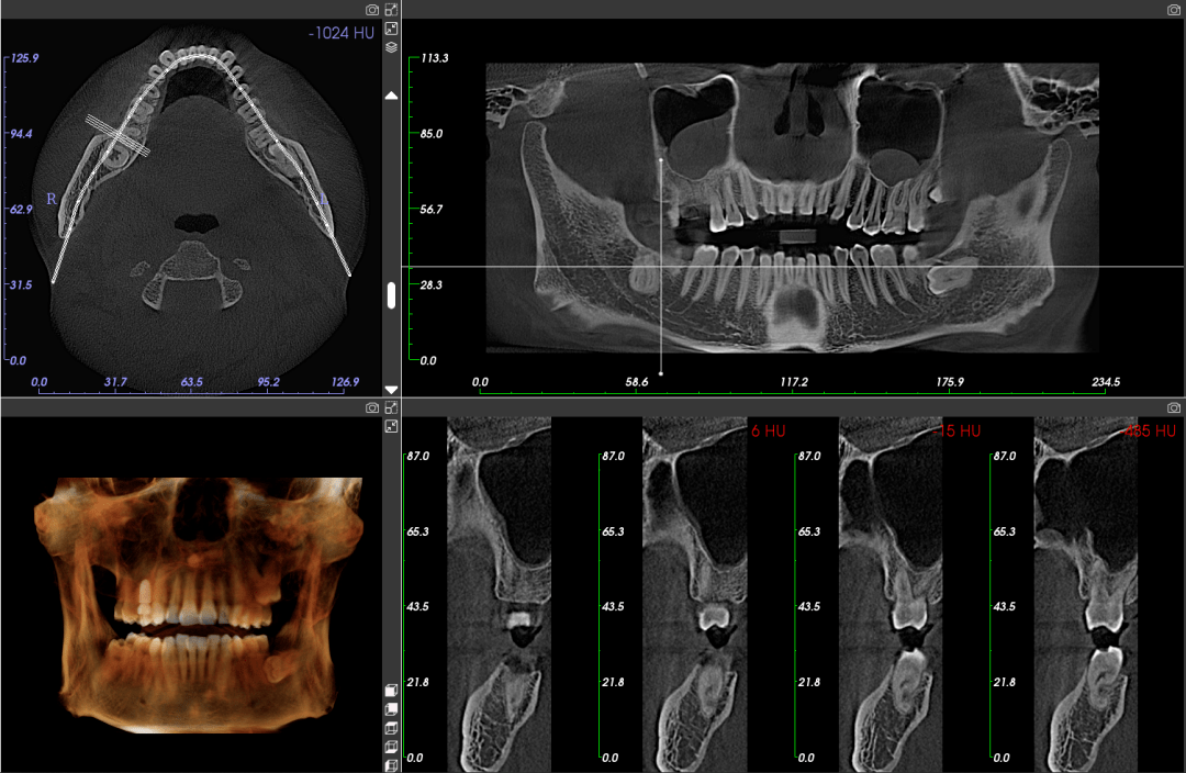 口腔cbct成像视野大pk看完你就知道怎么选了