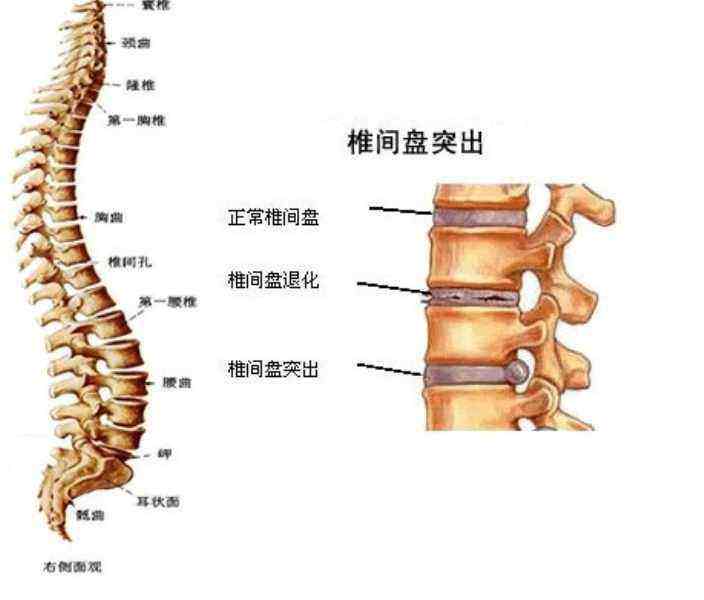 腰间盘突出应该多运动还是多休息?_腰椎间盘